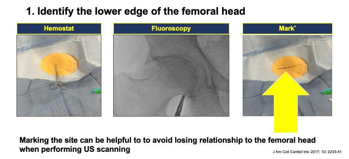 Vascular Access for percutaneous interventional procedures step 1