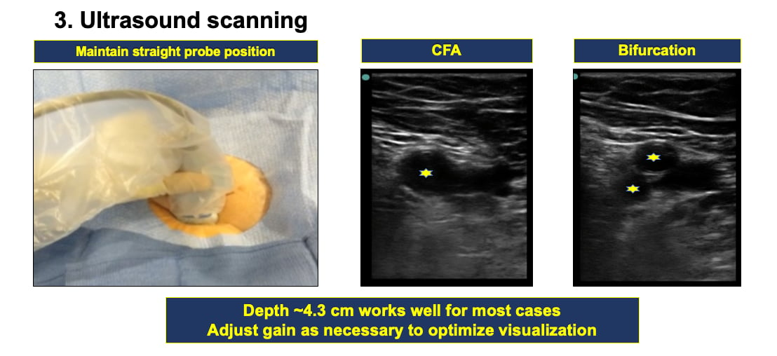 Vascular Access for percutaneous interventional procedures step 3