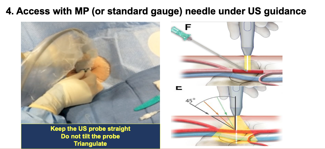 Vascular Access for percutaneous interventional procedures step 4