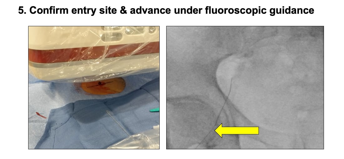 Vascular Access for percutaneous interventional procedures step 5