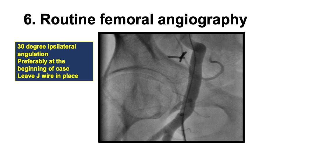 Vascular Access for percutaneous interventional procedures step 6