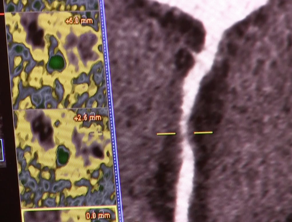 An example of coronary CT angiography plaque assessment software offered by Siemens Healthineers.