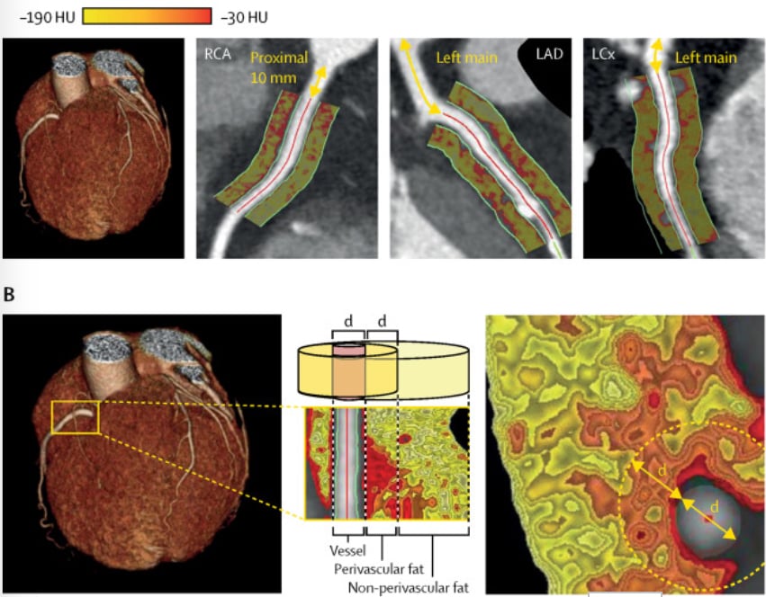 Example of FAI plaque imaging