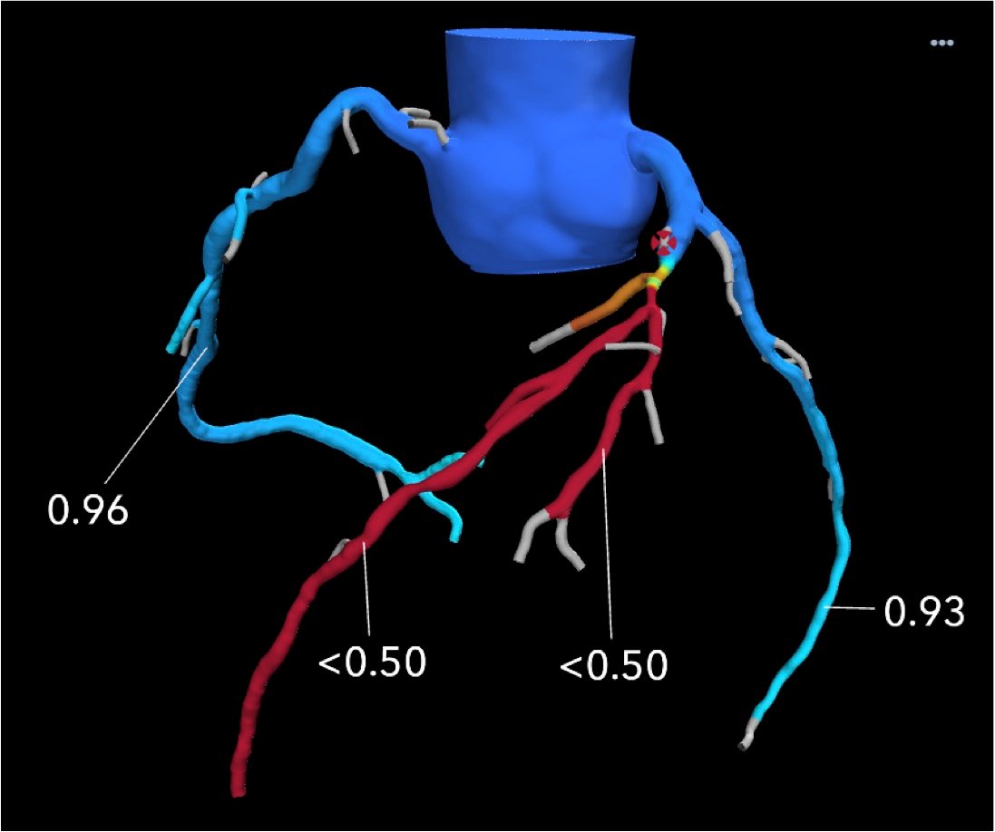 Example of an FFR-CT coronary tree showing vessel occlusion that requires revascularization.