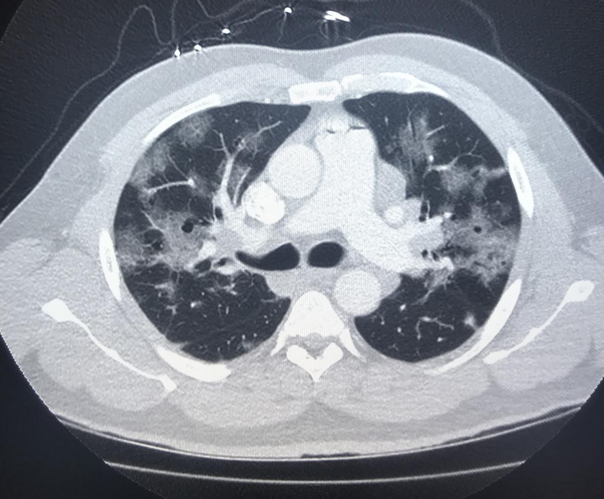 CT scan showing COVID-19 ground glass lesions in the lungs and the top of the heart.