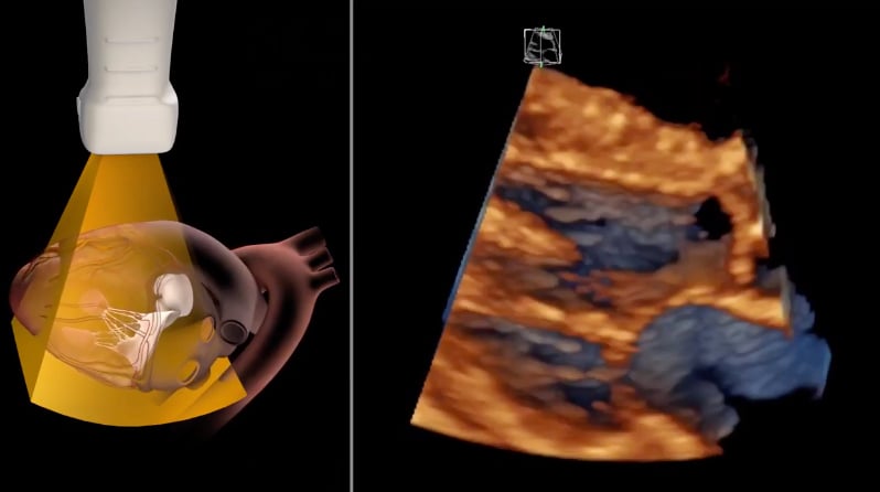 GE Healthcare's cSound 2.0 echocardiography image processing technology.