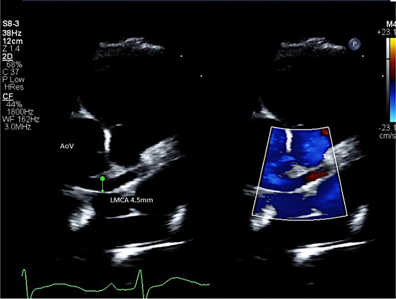 MIS-C pediatric patient echocardiogram