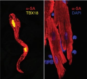 TBX18 over expression includes transdifferentiation of cardiac myocytes toward pacemaker like cells.