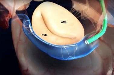 Carillon Mitral Contour device for TMVR