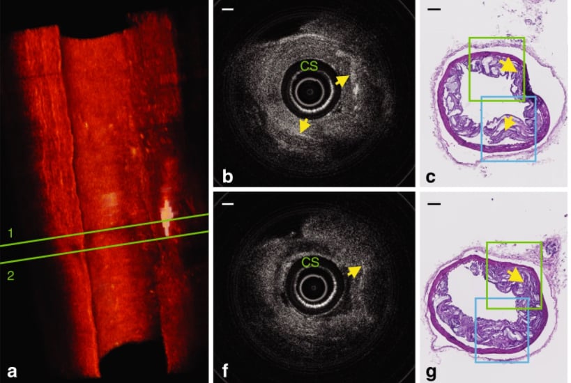 Use of 3D printing enabled the production of an OCT catheter the width of a human hair.