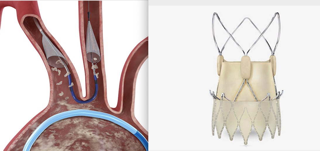 The Boston Scientific Sentinal and Acurate Neo2 TAVR valve