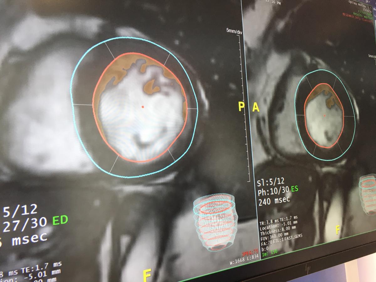 AI automated cardiac MRI image analysis software offered on TeraRecon's Envoy AI platform. Several vendors at RSNA 2020 were showing AI algorithms to automate the contouring of anatomy and quantification, which can greatly speed MRI exams when most of the time consuming work is completed before the radiologist reads the exam. Photo by Dave Fornell at RSNA 2019.