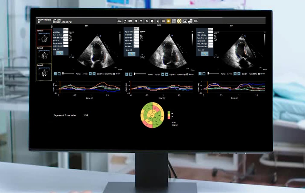 Dia's LVivo artificial intelligence software can help automate many features of echocardiograms to speed workflow and aid novice users. The software is now integrated into the Konica Minolta Exa PACS. 