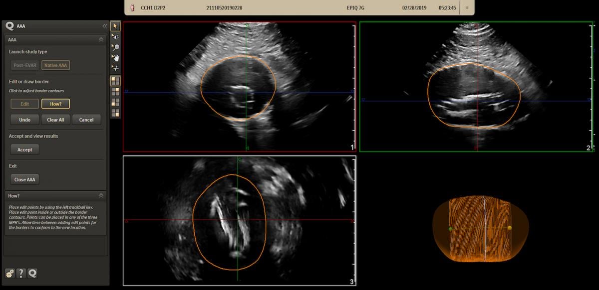 Philips Epiq AAA ultrasound assessment software can help diagnose and monitor aortic aneurysms. 