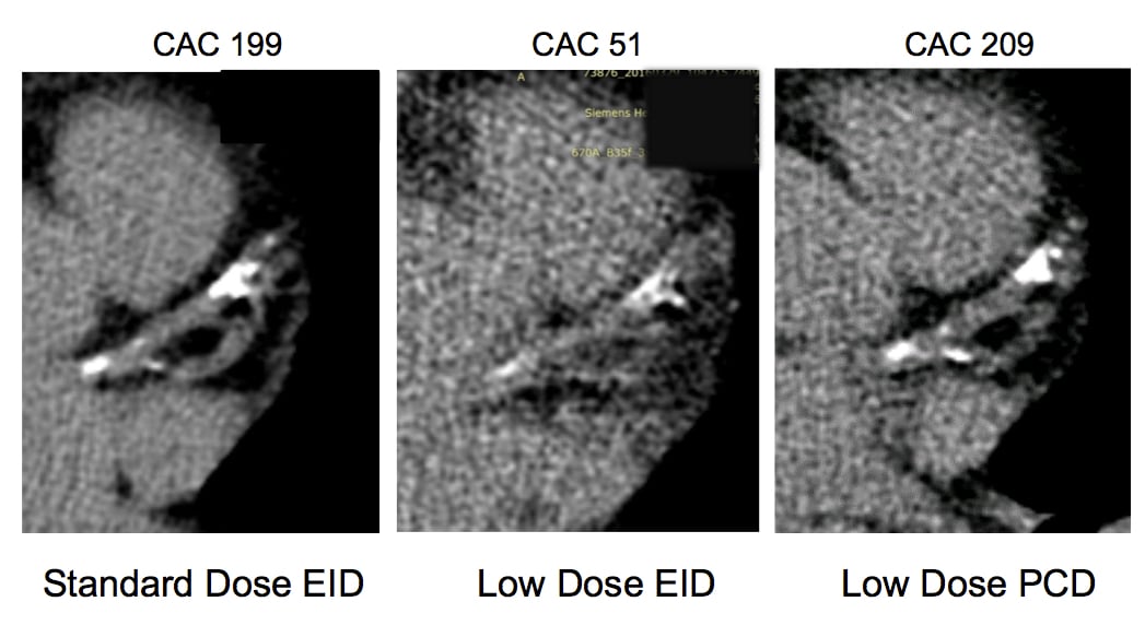 The impact of photo-counting CT detectors on coronary artery calcium (CAC) scoring. Photon-counting detectors will be able to greatly reduce the amount of radiation used to create CT images and will be able to show more detail in those images. This series of images shows CAC scoring changed based on the imaging technology used.