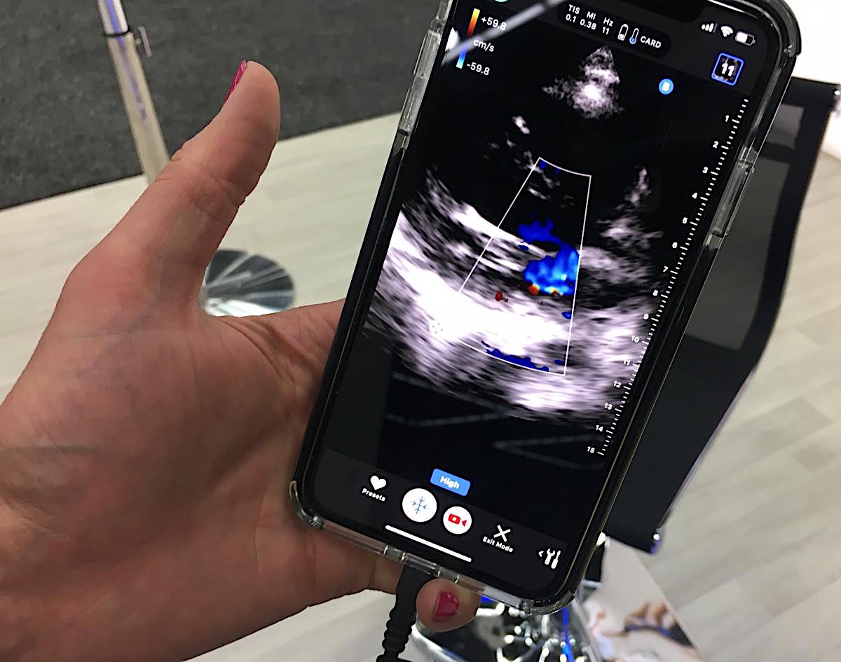 An echocardiogram being performed with a smartphone using the Butterfly Network technology at the 2019 ASE meeting. Photo by Dave Fornell.