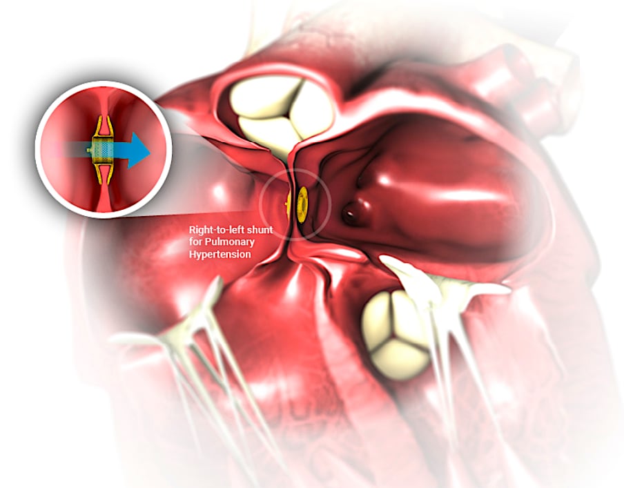 The Occlutech implantable Atrial Flow Regulator (AFR) maintains an interatrial shunt with a predetermined diameter allowing for controlled blood flow from the left to the right atrium enabling the left atrium to decompress and lower left atrial pressure. This reduced left atrial pressure reduces heart failure symptoms and improves exercise tolerance.