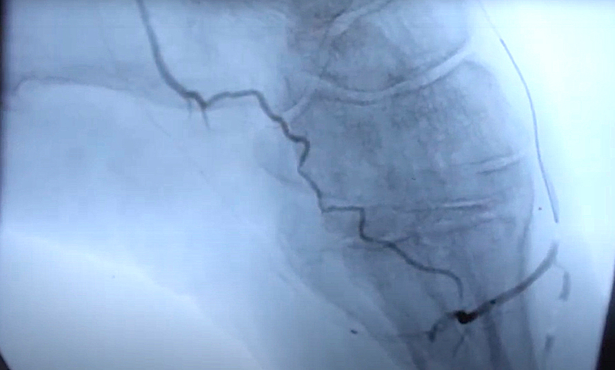 Peripheral artery disease in the arteries around and below the knee, from an angiography image during a procedure at a Modern Vascular clinic.