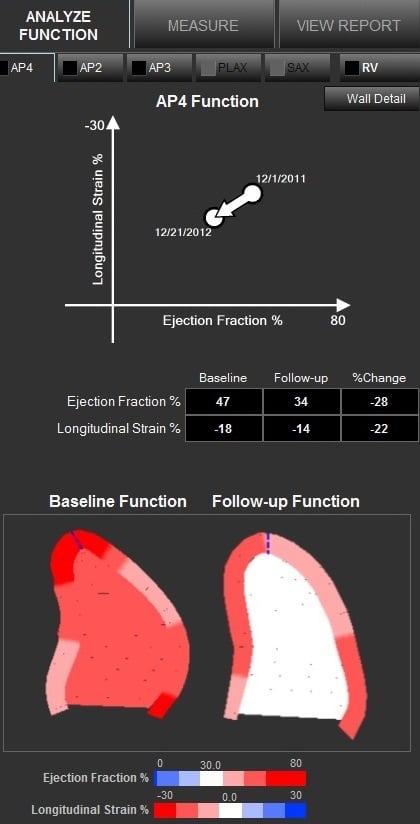 An example of cardiac ultrasound longitudinal strain measurements on the Epsilon EchoInsight software. This can be used to assess cardiotoxicity in cardio-oncology patients.