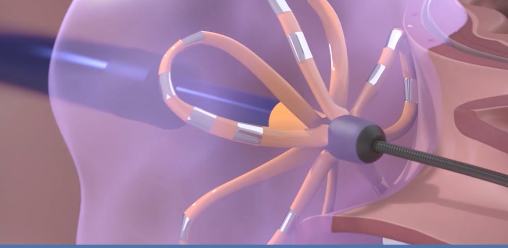 Farapulse pulsed field ablation system illustration as it is used for pulmonary vein isolation.