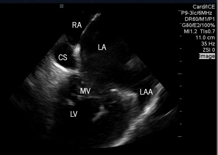 Example of the Abbott/St. Jude Medical 2-D intracardiac echo (ICE) system showing cardiac anatomy.