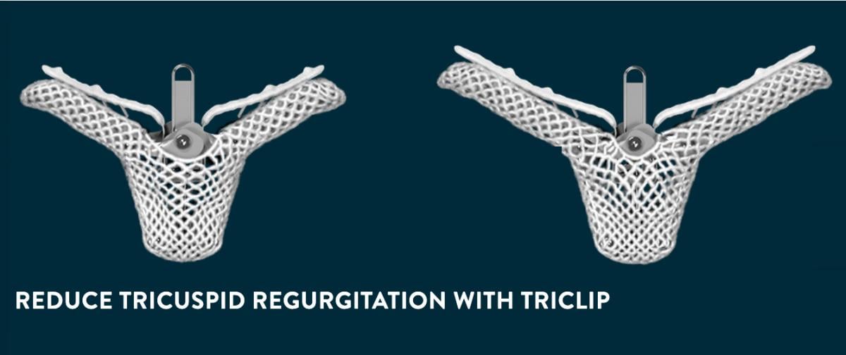 The Abbott TriClip device fort transcatheter repair of the tricuspid valve.