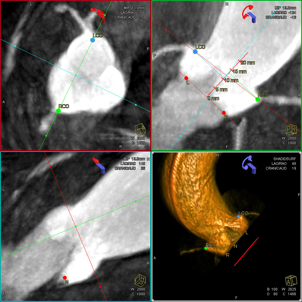 A TAVR patient pre-procedure CT imaging workup with the measurements required for device sizing and to see if there may be any issues during the implant.