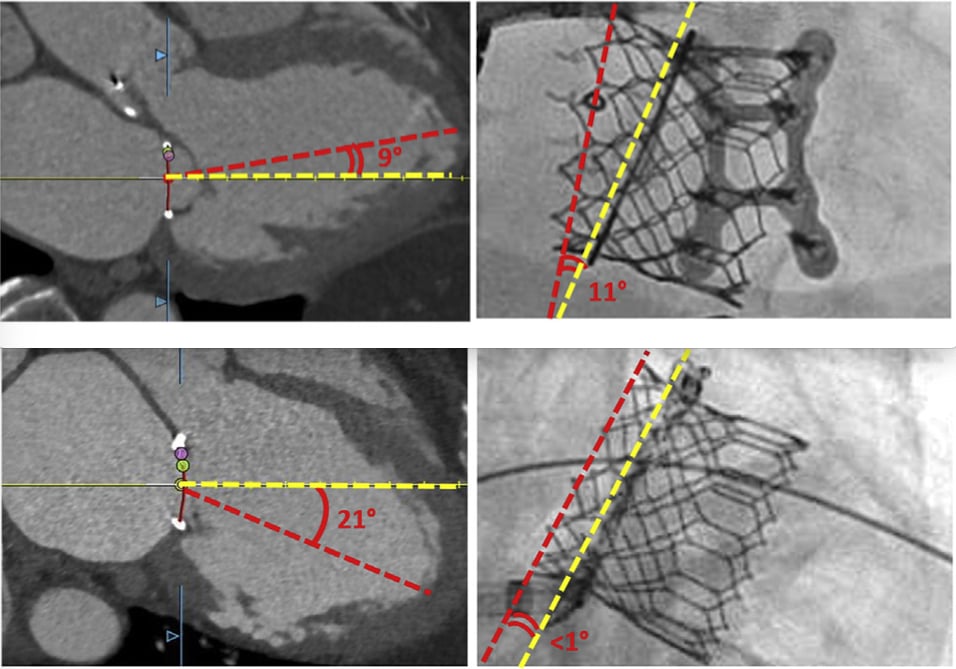 The Emory Angle: Two representative cases demonstrate the canting angle before (E to G) and after (H to J) adopting the new strategy. (E to G) CT-derived Emory angles in (E) bicommissural (medial-lateral) and (F) LV outflow tract (anteroposterior) planes with (G) noncoaxial (canted) deployment evident on fluoroscopy in a case before we adopted selective guidewire exteriorization. (H to J) A case that illustrates improved valve alignment despite large Emory angle by externalizing the guidewire through a percutaneous para-apical sheath. Image courtesy of Kendra Grubb, M.D.