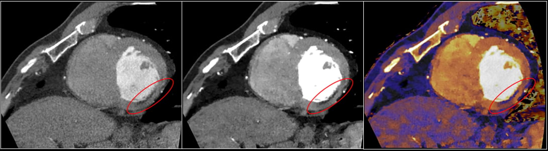 Cardiac spectral imaging of an infarct.