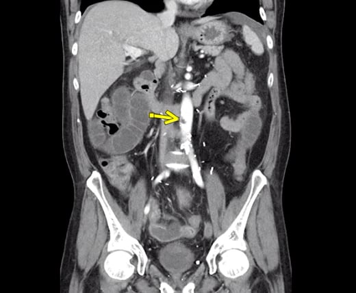 COVID caused aortic thrombosis clotting.