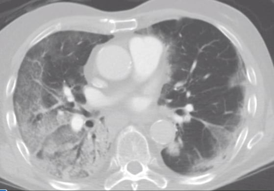 COVID pneumonia in a CT scan, shown as the cloudy areas in the lungs, which should be black in healthy patients.