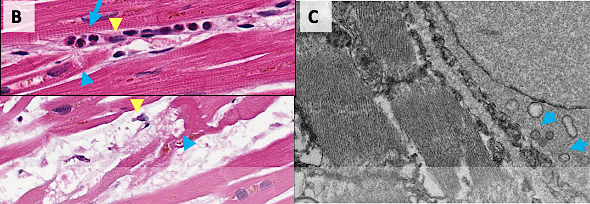 Image icon Circulation_COVID19_damage_in_cadaver_hearts