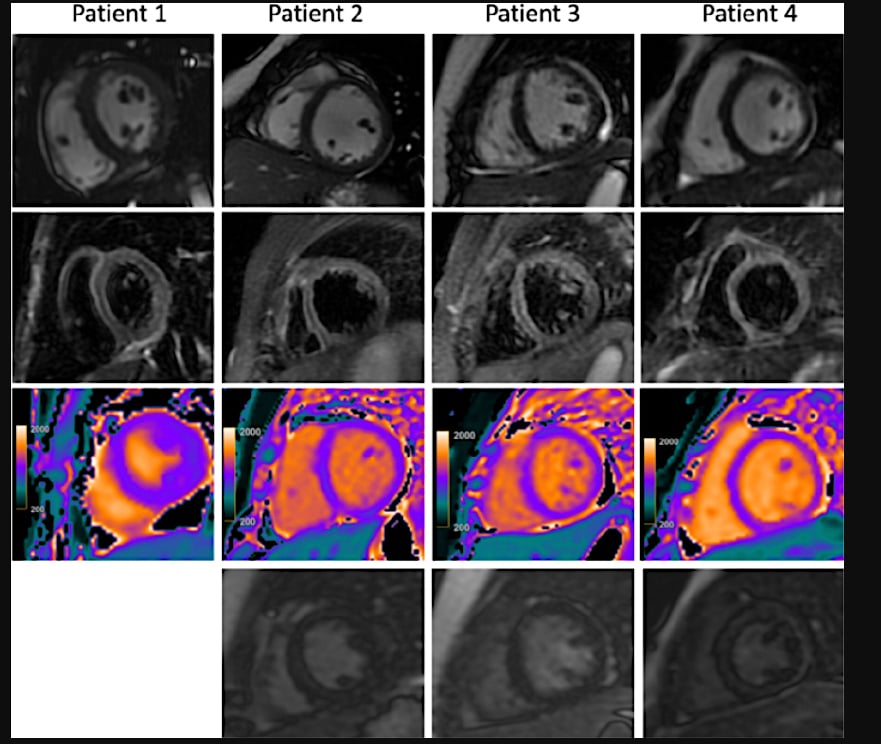 MIS-C MRI Pediatric COVID patient