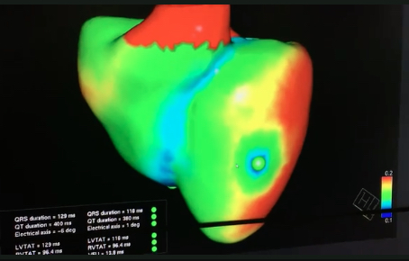 Siemens Healthineers digital twin of a heart created from patient imaging and diagnostic testing data used to find the optimal position of ICD lead placements.