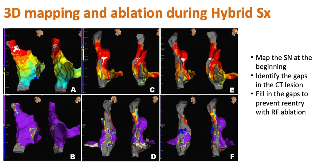 A recent study unveiled a novel sinus node ablation technique that provides a safe and effective treatment option for patients suffering from symptomatic, drug-resistant inappropriate sinus tachycardia (IST). Results of the Susruta-IST Registry were presented as a late-breaking clinical trial at Heart Rhythm 2021, the annual meeting of the Heart Rhythm Society (HRS). #HRS21 #HRS2021