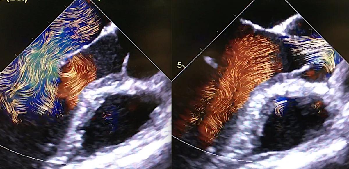 Examples of GE Healthcare's echo blood flow imaging technique using a combination of high frame rate imaging with blood speckle tracking. It shows how the blood flows within the heart. It uses arrows showing direction of flow and color coding showing the velocity. This technique can clearly show vortices created by swirling blood, which are believed to play a role in the early disease development that cause valve issues and heart failure. It also can be used to better assess the hemodynamics of congenital Heart defects. The software is being developed for the E95 system.