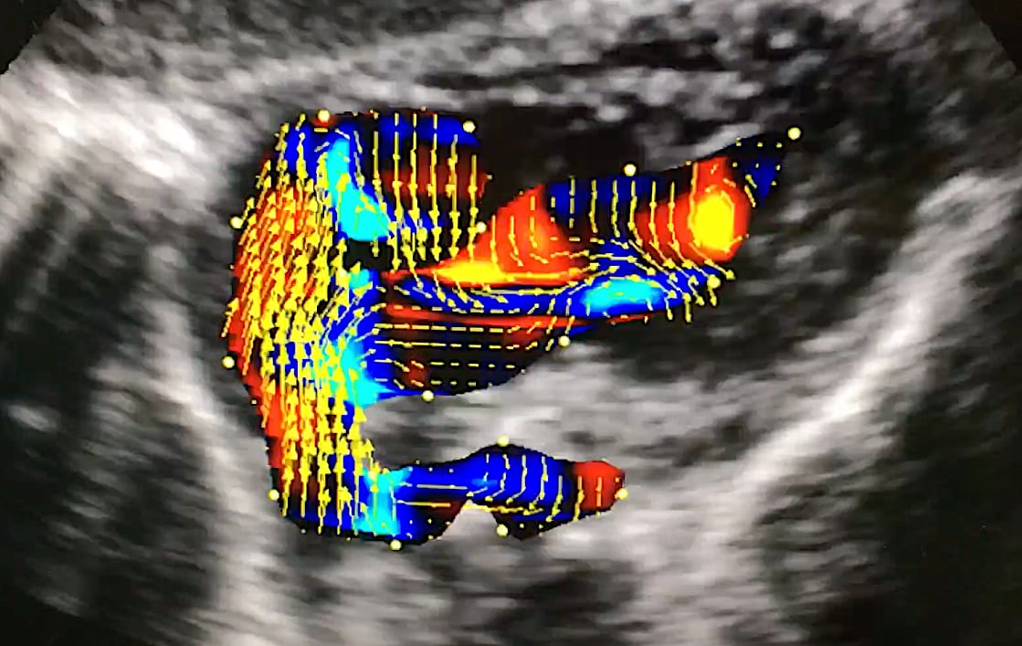 An example of vector flow imaging offered on the Hitachi Lisendo 880 cardiac ultrasound system. Arrows show the direction of the flow and the color coded areas show the velocity. Photo by Dave Fornell at ASE 2018. 