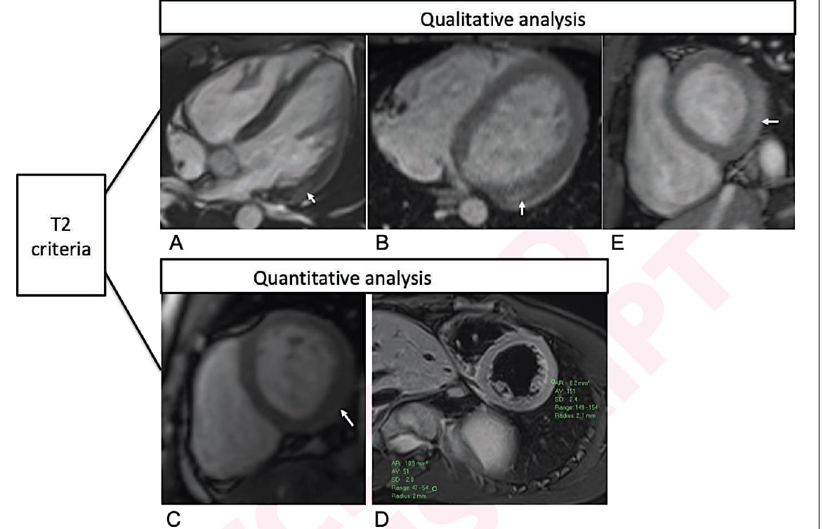 Figure 2. Qualitative and quantitative T2-based criteria for myocarditis on cardiac MRI in patients with recent COVID-19. mRNA vaccination. Qualitative criterion was focal myocardial edema and is shown on 4-chamber precontrast SSFP image (arrow) in 16-year-old male (A) and 17-year-old male (B). Quantitative criteria included T2 parametric mapping and quantification of myocardial signal intensity ratios. Focal subepicardial edema of the basilar left ventricular inferior wall (arrow) is shown on source image from T2 mapping in 17-year-old male (C). Increased myocardial signal intensity ratio of 3.0 at mid-cavity is shown in 19-year-old male (D). Qualitative focal myocardial edema is also shown on short-axis precontrast SSFP image (arrow) in 17-year-old male (E). Patients in A-E correspond with patients A-E in Table 1, respectively.[1]