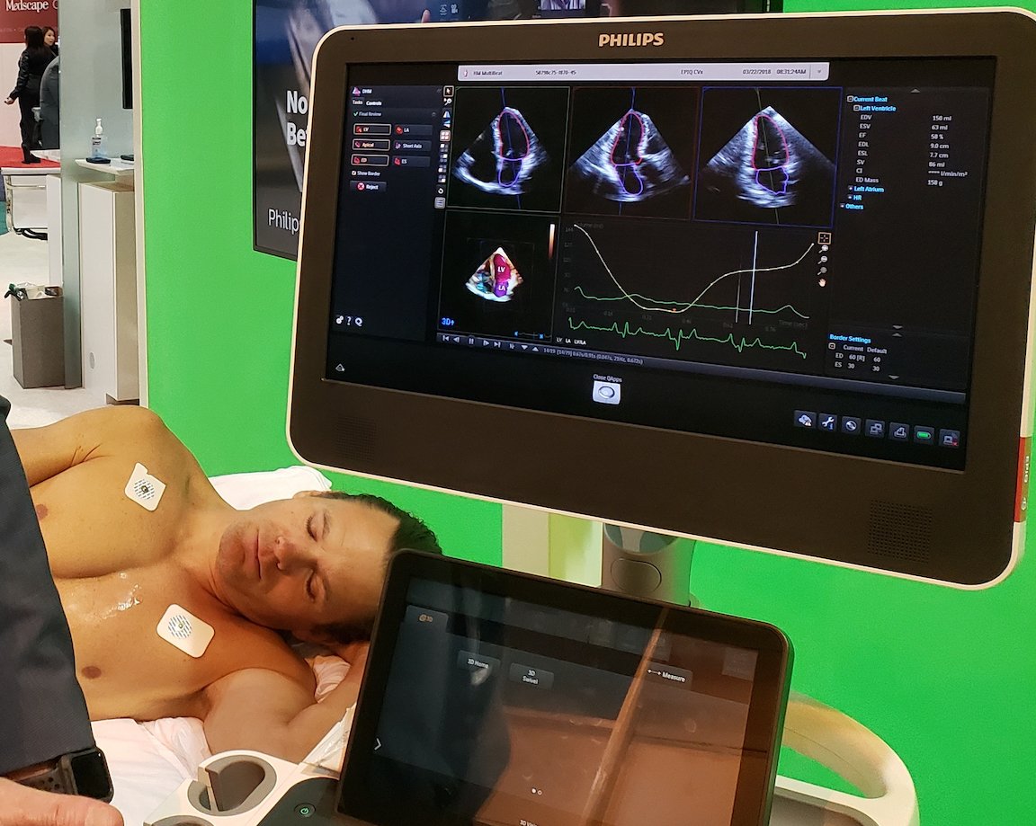 Philips’ artificial intelligence-based dynamic heart model on the Epiq CVx system automatically identified the anatomy and shows the ideal cardiac echo views.