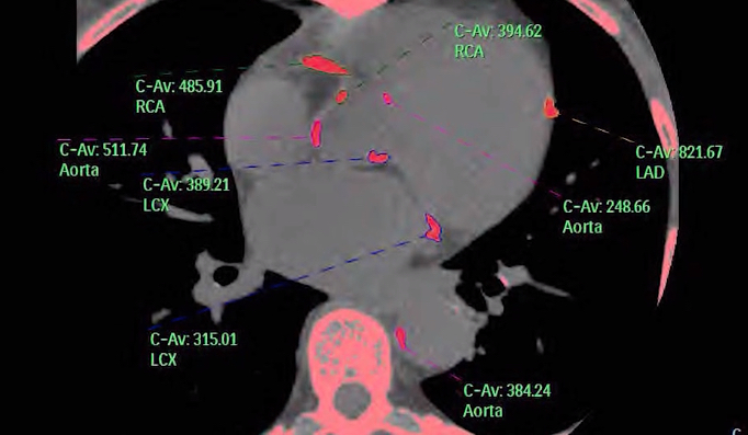 An example of a calcium scoring exam where the software automatically identifies the calcium in each vessel segment and quantifies it to create an overall Agatston risk score.