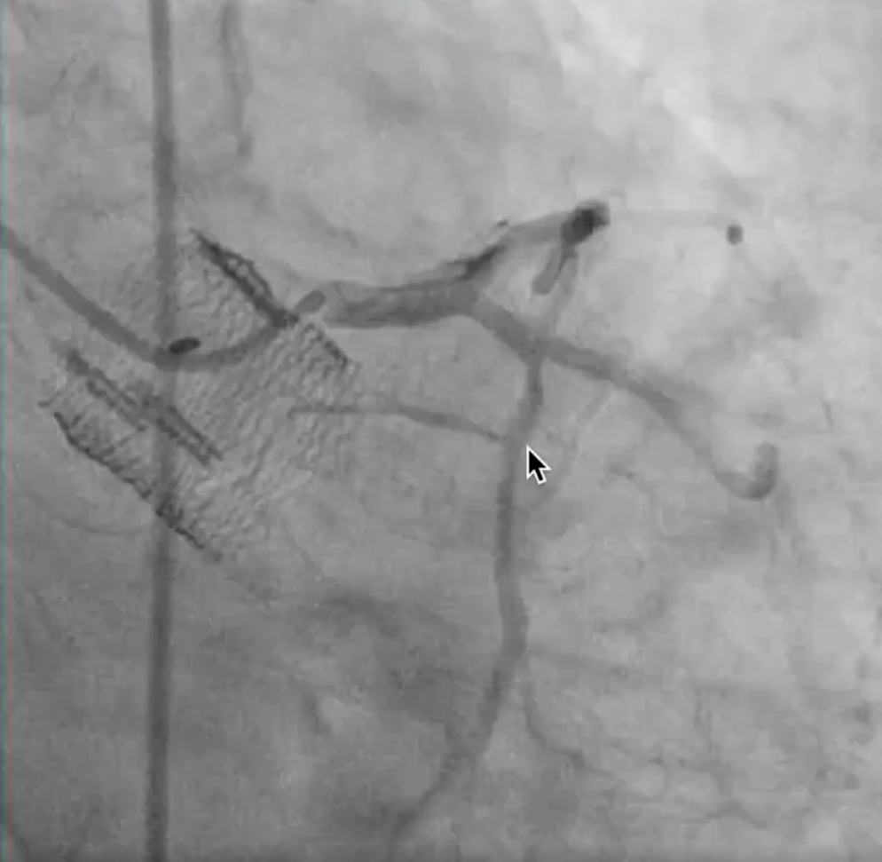 This is an angiographic view of a deployed transcatheter Lotus aortic valve.  