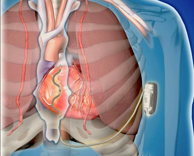 The Medtronic Extravascular ICD, or EV-ICD, system.