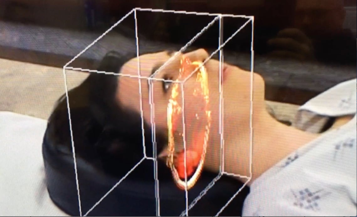 Novarad augmented reality for surgical planning.