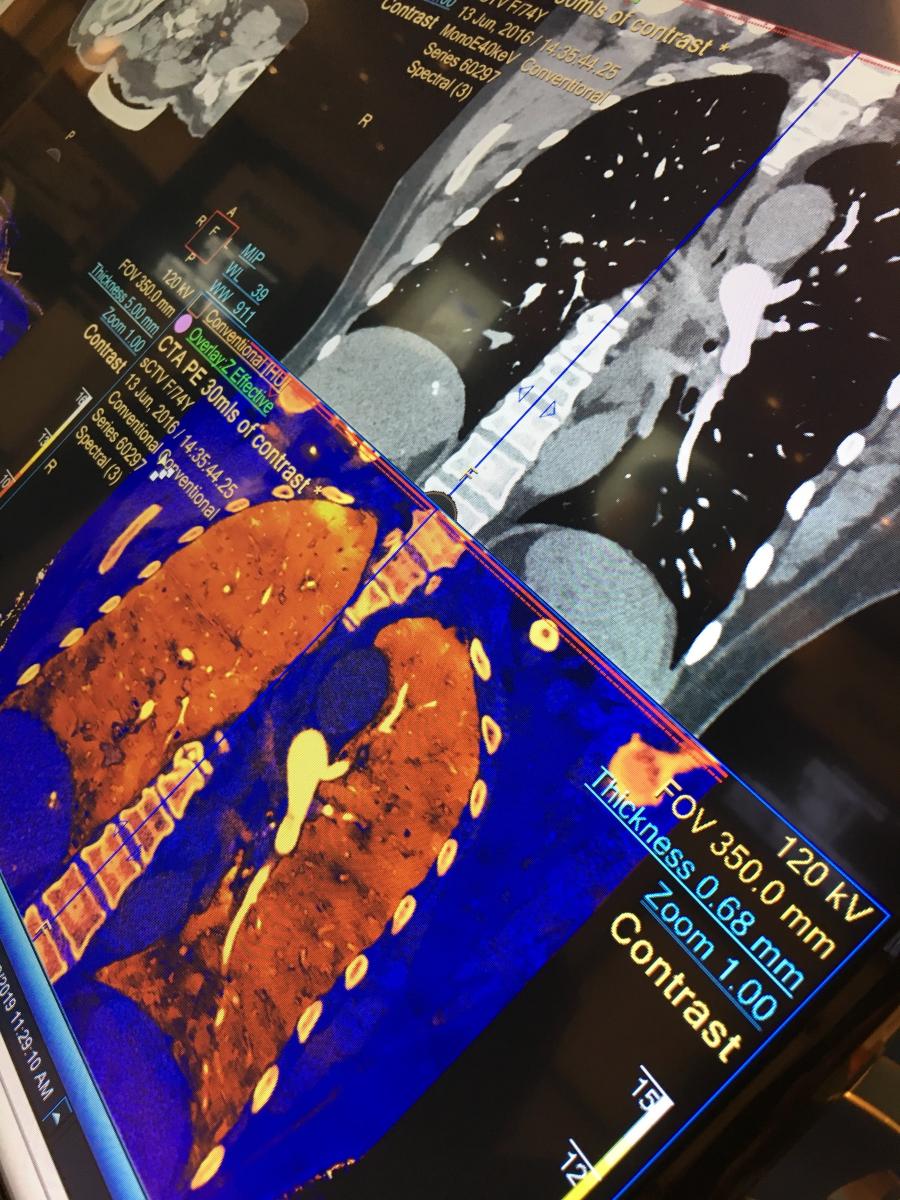 An example of spectral CT imaging from Philips showing an iodine map with dark areas in the lower lungs, which make pulmonary embolisms easier to visualize. 