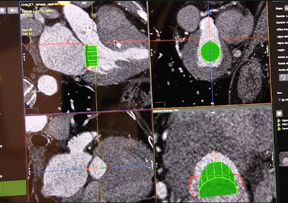 An example of an evaluation for the neo-left ventricular outflow tract (neo-LVOT) on CT imaging for a transcatheter mitral valve replacement using Circle Imaging's advanced visualization software. TMVR assessment