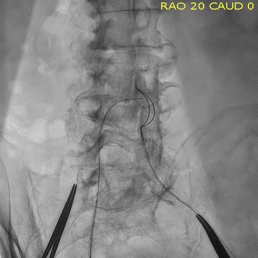 Transcaval access TAVR procedure seen on a Philips Azurion angiography system at Henry Ford Hospital.