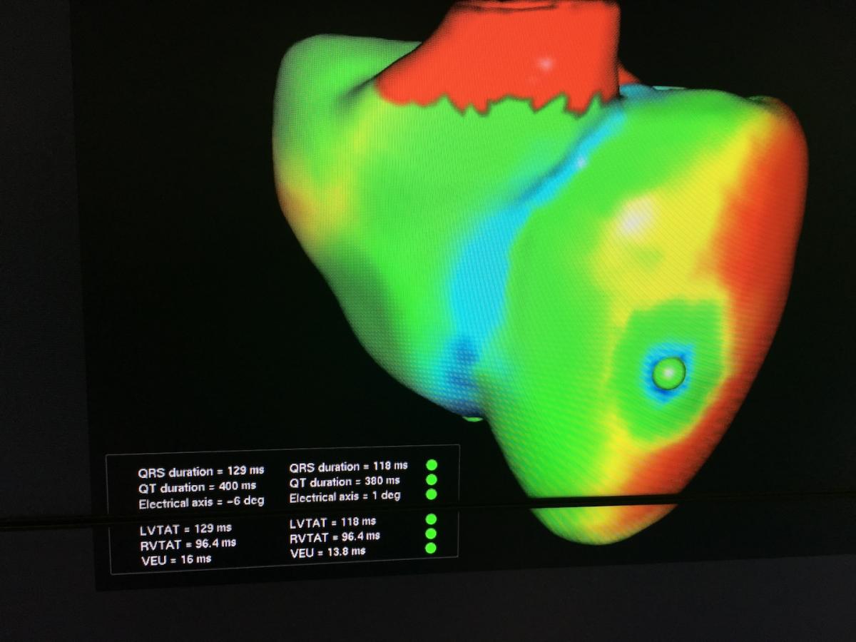 Siemens organ twin virtual heart.