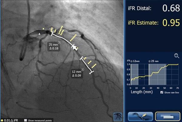 Philips iFR Technology can be used to personalize healthcare for cardiac patients in the cath lab.