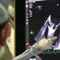 MitraClip procedure guided under TEE echo at the University of Colorado.