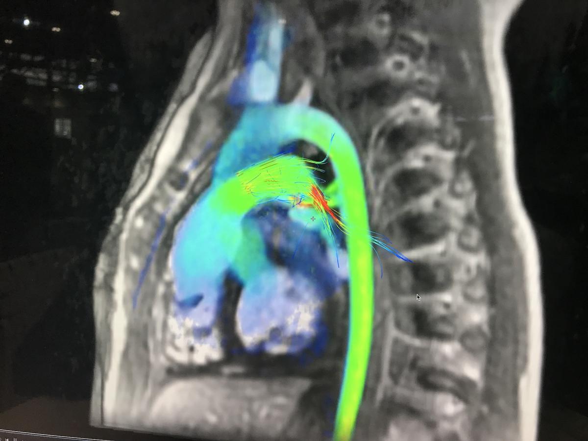 Arterys AI-based cardiac MRI blood flow assessment software can help reduce the time it takes to make measurements and evaluate cardiac function. 